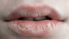 Vergiss rissige Lippen – dieses Hausmittel macht sie wieder weich